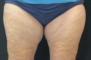 CoolSculpting