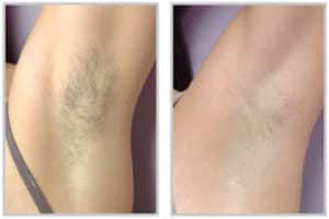 1764728955_laser-hair-removal-underarms-before-after-300x200-1 Laser Hair Removal