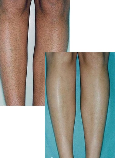 1764728967_layer-101-1 Laser Hair Removal