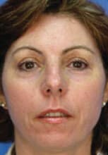 1764729253_Layer-90-1 Microlaserpeel