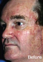 1764729258_Layer-91 Microlaserpeel