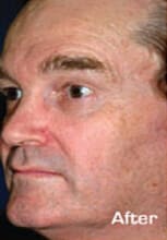 1764729264_Layer-92 Microlaserpeel