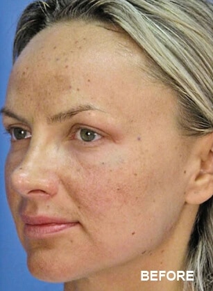 1764729270_Layer-94-1 Microlaserpeel