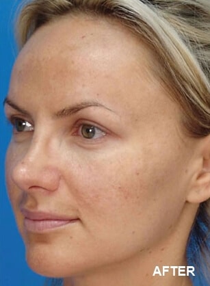 1764729277_Layer-95 Microlaserpeel