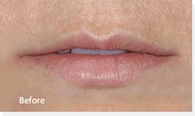 1764729500_Layer-73 Restylane